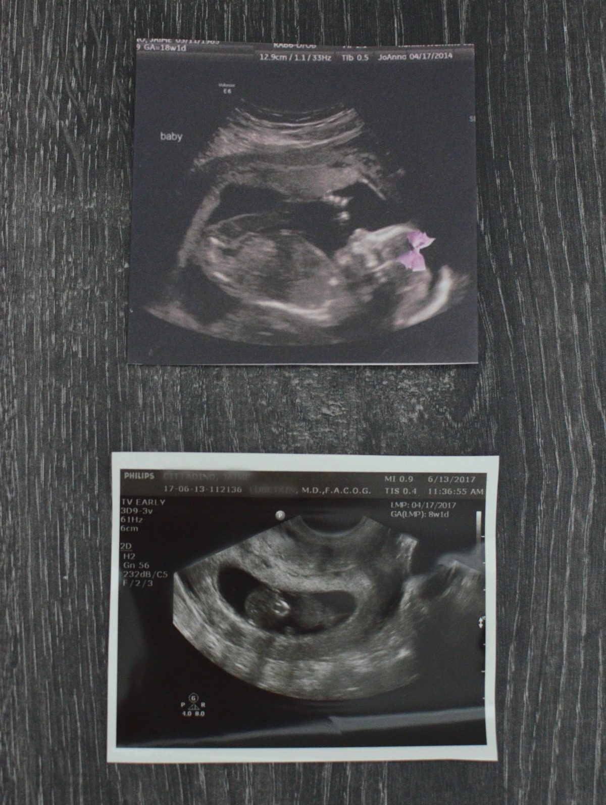 Baby Sonogram Pictures